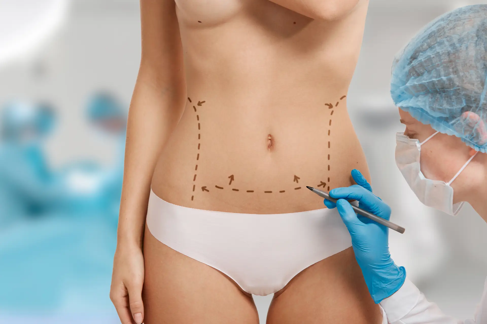 Abdominoplastia o lipectomía abdominal en Bogotá