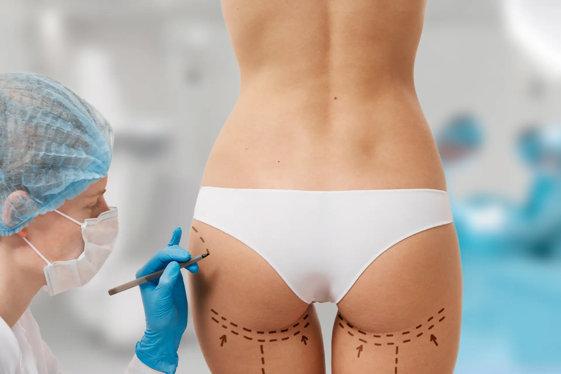 Gluteoplastia, aumento de glúteos en Bogotá