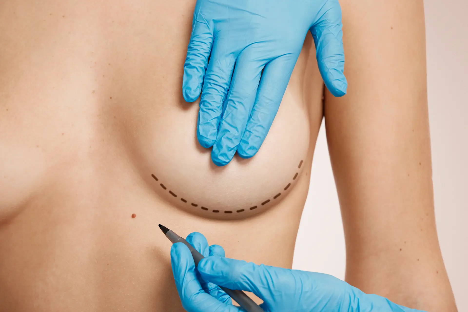 Cirugía de senos o mamoplastia en Bogotá